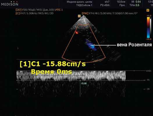 Вена розенталя. Вена Розенталя на УЗИ. Вена Розенталя и Галена на УЗИ. Вена Галена на УЗИ. ЛСК В венах Розенталя.
