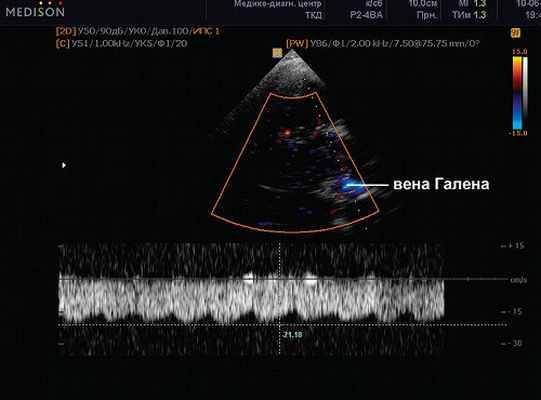 Кровоток галена. НСГ Вена Галена норма. Вена Галена 11 см/с. Вена Галена УЗИ НСГ.