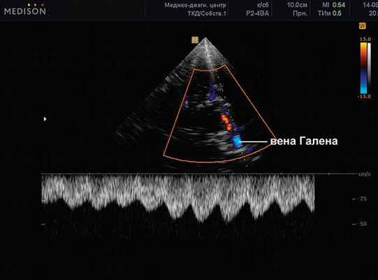 Вена галена кровоток. Вена Галена анатомия на УЗИ. Вена Галена УЗИ НСГ. Вена Галена Вена Розенталя на УЗИ.