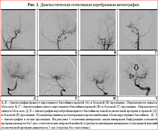 Болезнь моя моя. Болезнь моя моя ангиография. Церебральная ангиография проекции. Прямая селективная ангиография.
