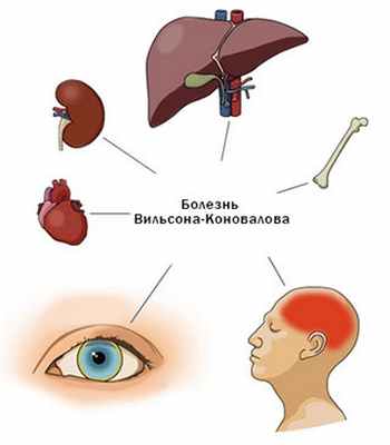 Болезнь вильсона. Вильсона Коновалова коплика. Петля Вильсона.