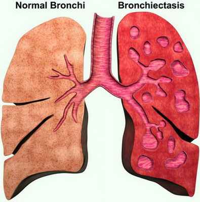 Симптомы и лечение бронхоэктазы легких