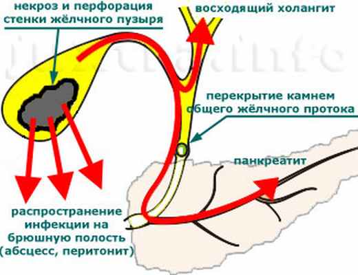 Нарушение желчного оттока. Острый холецистит перфорация желчного пузыря. Перфорация стенки желчного пузыря. Перфорация желчного пузыря патогенез. Лимфоотток желчного пузыря.