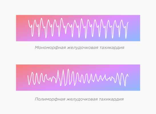 Мономорфная желудочковая тахикардия. Тахикардия. Тахикардия сердца причины. Желудочковая атрофия сердца кардиограмма.