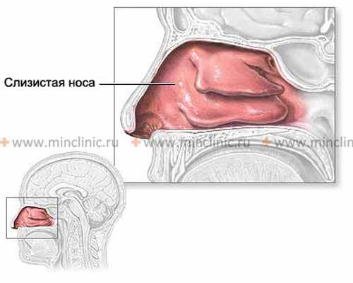 Носовая слизь состав. Гипертрофический ринит прижигание. Вазомоторный ринит слизистая. Катаральный ринит слизистая оболочка носа. Острый катаральный ринит.