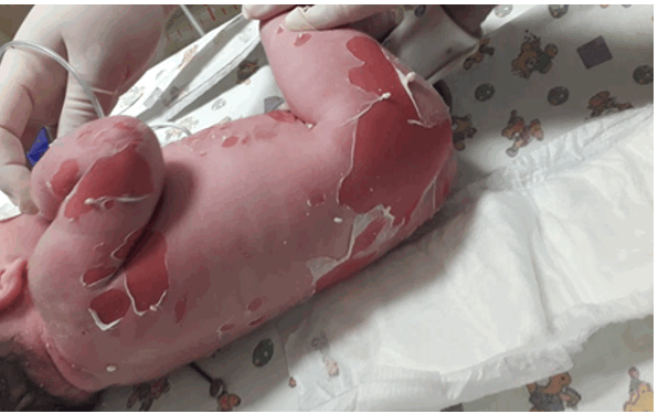 Эпидермолитический гиперкератоз у новорожденного