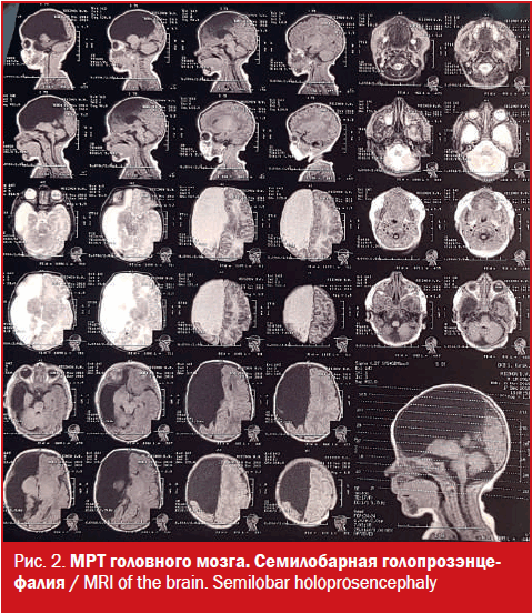 Фото гипоспадия головчатая форма