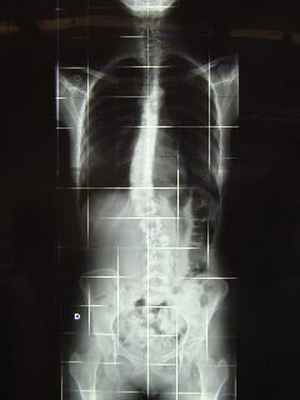 Сколиограмма в в прямой проекции