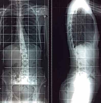 Caso de escoliosis 2014