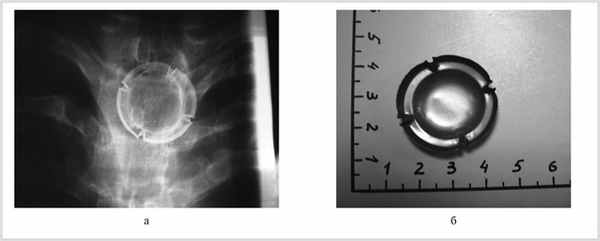 Кольцо шацкого в пищеводе. Кольцо Шацкого рентген. Кольцо Шацкого в пищеводе рентгенограммы. Кольцо Шацкого эндоскопия. Кольцо Шацкого эндоскопическая картина.