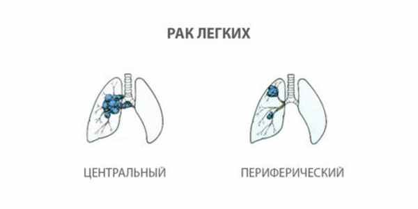 Периферический рак. Центральный и периферический рву. Центральные опухоли легкого и периферические. Центральная и периферическая локализация опухоли. Мокрота при онкологии легких.