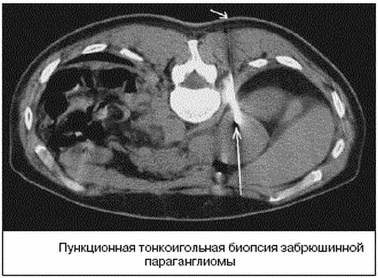 Забрюшинные неорганные саркомы. Опухоли забрюшинного пространства кт. Внеорганные опухоли брюшной полости на мрт. Забрюшинные внеорганные опухоли мрт. Киста забрюшинного пространства.