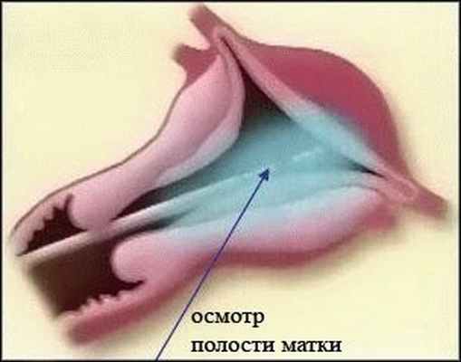 Синехии у девочек. Гистероскопия синехии. Синехии цервикального канала. Синехии полости матки гистероскопия.