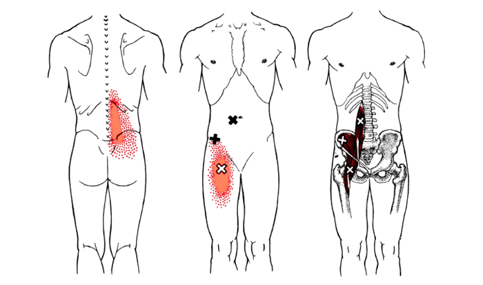 Подвздошно-поясничная мышца анатомия. Подвздошно-поясничная мышца триггерные точки. Миофасциальный синдром подвздошно-поясничной мышцы. Подвздошная мышца спины. Поясничной области внизу живота