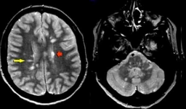 Фото мрт при рассеянном склерозе