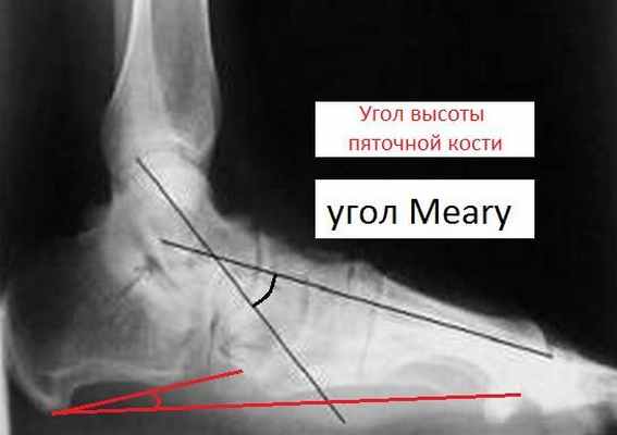 Кости угол. Таранно-пяточный угол рентген. Таранно пяточный угол. Угол пяточной кости. Таранно пяточный угол на рентгенограмме.