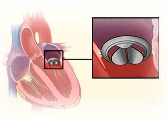 Противофаза клапана. Клипирование митрального клапана. Митральный клапан противофаза есть что это. Протез митрального клапана. Уплотнение митрального клапана.