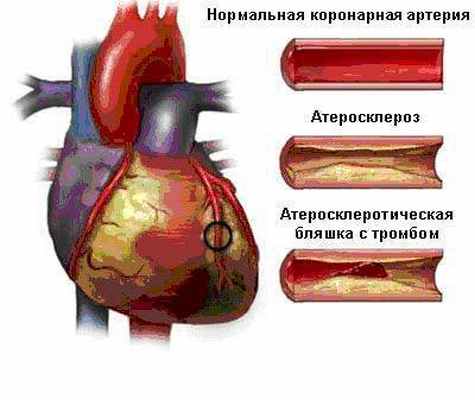 Тромбоз коронарных артерий. ИБС атеросклероз коронарных артерий. Осложнения атеросклероза коронарных артерий. Стенозирующий атеросклероз коронарных артерий 3 степень. Профилактика атеросклероза коронарных артерий.
