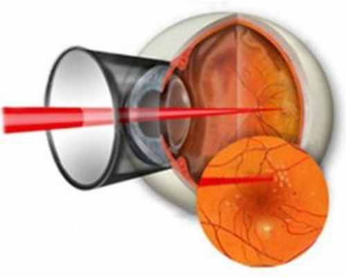 Лазерная коагуляция сетчатки. Коагуляция сетчатки глаза. Лазер коагуляция сосудов сетчатки глаза. Отграничивающая лазерная коагуляция сетчатки.