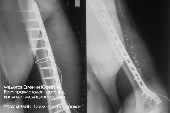 Операция смещения. Остеосинтез пластиной плечевой кости в н/3. Остеосинтез диафиза плечевой кости пластиной. Перелом плечевой кости со смещением операция. Перелом плеча со смещением операция.