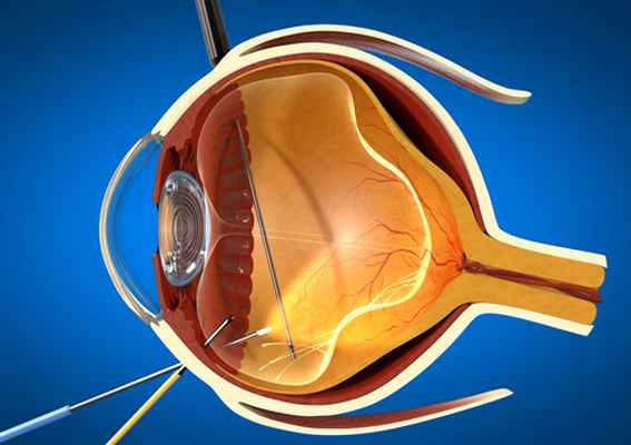 Пломбирование сетчатки. Витрэктомия ретинопатия. Витрэктомия лазеркоагуляция сетчатки. Операция витрэктомия глаза. Витрэктомия отслоение сетчатки.