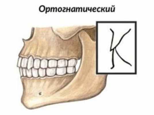 Прямой прикус картинка