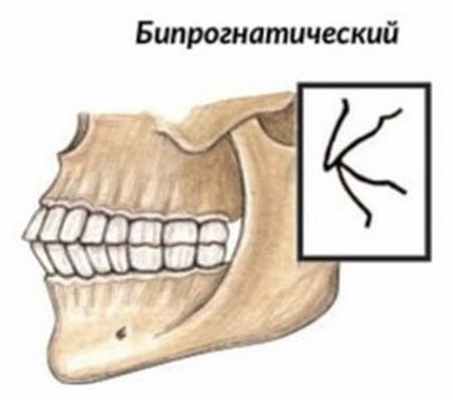 Прямой прикус картинка