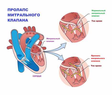 Пролапс митрального клапана 4мм