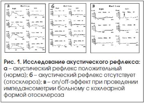 Акустическая рефлексометрия. Акустическая импедансометрия Тип в. Отосклероз импедансометрия. Акустический рефлекс на тимпанограмме. Акустическая импедансометрия при отосклерозе.