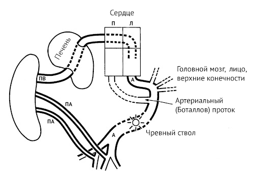 Агенезия венозного протока