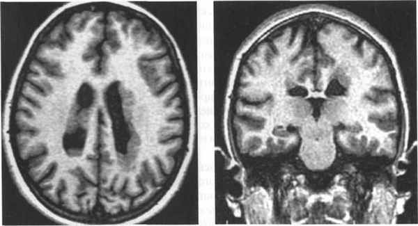 Субкортикальные очаги глиоза в белом веществе