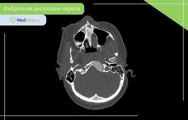 Дисплазия черепа. Фиброзная дисплазия основания черепа на кт. Фиброзная дисплазия костей черепа. Фиброзная дисплазия костей черепа на кт. Дисплазия костей черепа кт.