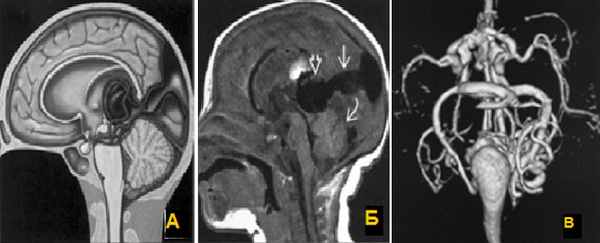 Гипоплазия левого поперечного синуса головного мозга. Мальформация вены Галена мрт. Аневризма вены Галена кт.