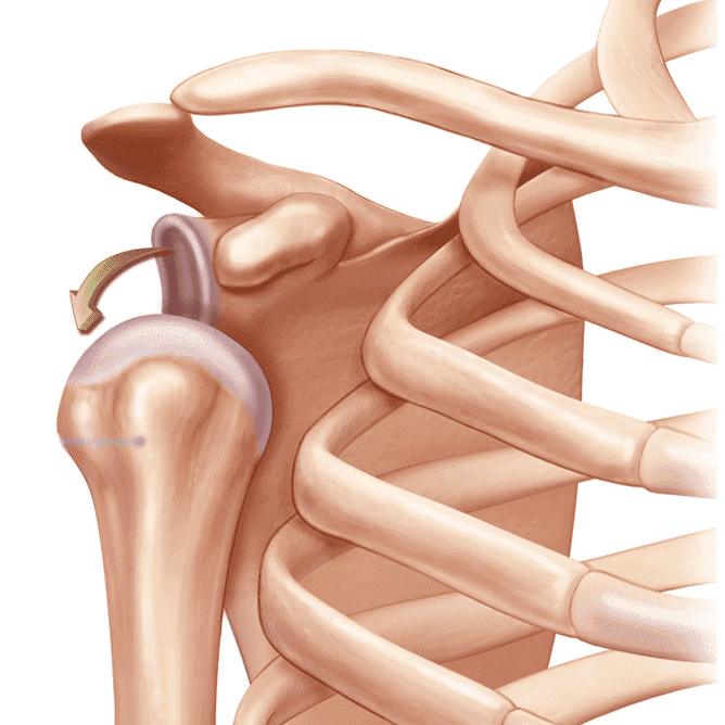 Вывих сустава. Плечелопаточный сустав,вывих. Вывих плечевого суставв. Привычный вывих плечевого сустава травма. Передний вывих плечевого сустава.