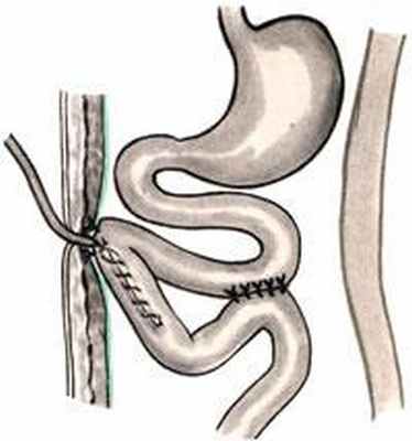 Еюностома. Еюностома по Майдлю техника. Еюностомия техника операции.