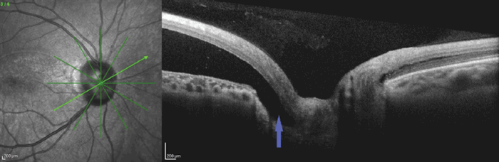 Окт дзн обоих. Ямка ДЗН зрительного нерва. Оптическая когерентная томография диска зрительного нерва.