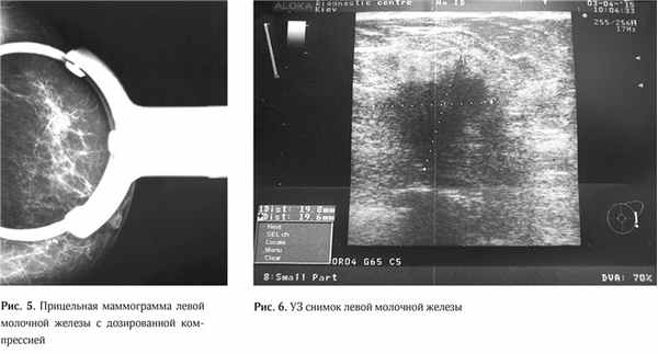 Clinical case granular cell tumor of breast3