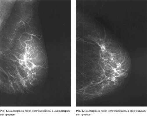 Clinical case granular cell tumor of breast 1