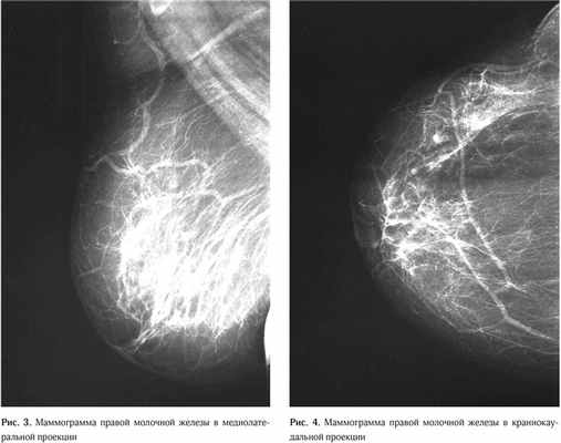 Clinical case granular cell tumor of breast 2