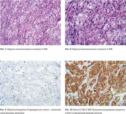 Clinical case granular cell tumor of breast4